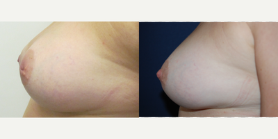 45-54 year old woman treated with Nipple Surgery - Inverted Nipple correction