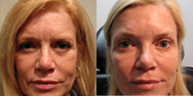 45-54 year old woman treated with Non Surgical Face Lift - Patient wanted to look refreshed.