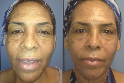 Pelleve full face before - Woman in her 50s before and after Pelleve treatment