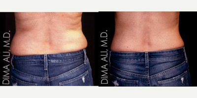 45-54 year old woman treated with UltraShape Power - Here you can see this patient received amazing results on her love handle area with UltraShape Power. UltraShape Power is the first and only FDA cleared non-surgical procedure with up to 32% fat reduction, the highest in the industry. UltraShape Power is a rapid fat reduction treatment that uses pulsed focused ultrasound to rapidly and comfortably destroy fat cells, resulting in measurable outcomes in as little as two weeks.