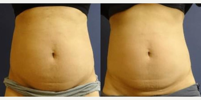 Woman treated with SculpSure - Woman treated with SculpSure