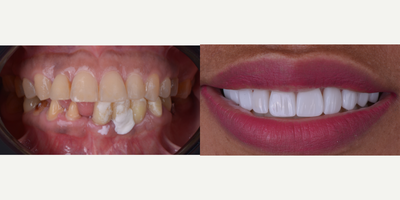 25-34 year old woman treated with Da Vinci Veneers, Dental Bridge, Dental Crown, Full Mouth Reconstruction, Lumineers, Porcelain - 10 Porcelain Veneers, dental bridge and crowns. color Bleach 1, texture and digital design.