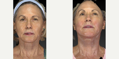 65-74 year old woman treated with Facelift - This very pretty woman was concerned about her jowl area and the excess skin under her neck. We did a lower face and neck lift with platysmaplasty.  Looking good!