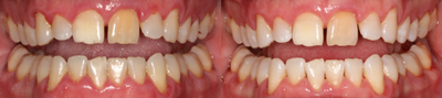 45-54 year old man treated with KoR Teeth Whitening - Patient came to the office to correct the imperfections that he has and wanted to whiten his teeth. Patient has had injury with an anterior tooth that has gotten darker than others and after one in-office session of Kor whitening, it has gotten significantly brighter and with conjunction of at-home whitening we will get an even better result.