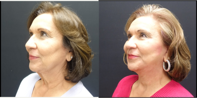65-74 year old woman treated with Neck Lift - The patient underwent a high lateral SMAS face and necklift. The SMAS elevation supports the facelift so that their is minimal tension on the skin and enhance the possible longevity of the face and necklift. Along with the face and necklift she also had fat transfer to the face. Fat was transferred tough out the face and temples to restore the volume she has lost over time as we age. The combination of tightening and filling of the face gives her a much more youthful but natural appearance. This pictures show her two month result.