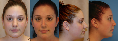 Nose job or Rhinoplasty - 
	This young patient was unhappy with nasal shape and form. Performed a rhinoplasty or nose job to improve her nasal hump and bulbous tip.&nbsp;
