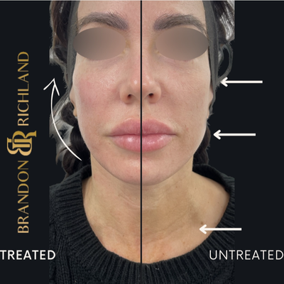 35-44 year old woman treated with Forma - Our red carpet treatment, better known as Forma skin tightening diminishes fine lines and gives an overall lifted appearance. The treatment is 12 minutes and lasts for ~72 hours, perfect for any upcoming events!