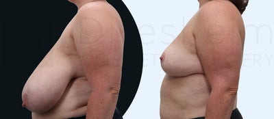 breast reduction - 
	Bilateral Breast Reduction, Very large breasts
