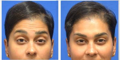 35-44 year old woman treated with Daxxify - Improved frown lines/ glabella, forehead, and crowsfeetInjected by Scarlet PA-C