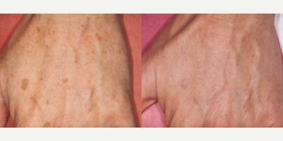 Woman treated with PicoWay - Woman treated with PicoWay