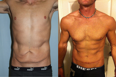 Male Tummy Tuck - 33 year old male tummy tuck.