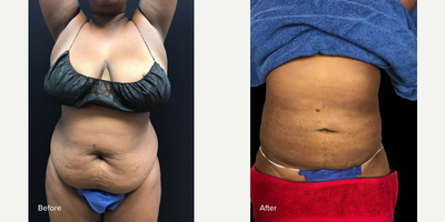 35-44 year old woman treated with Tickle Lipo and Renuvion - This state-of-the-art liposuction method can remove stubborn fat in a way that maintains patient comfort, reduces swelling and recovery time, and still provides outstanding results. Combine with Renuvion for even greater results!