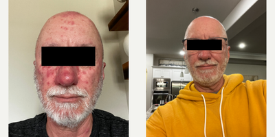 55-64 year old man treated with Accutane - Acne Treatment