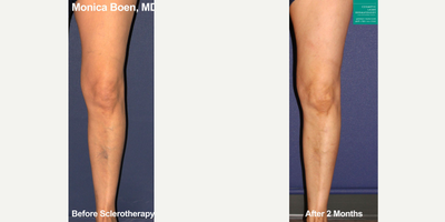 45-54 year old woman treated with Sclerotherapy - Sclerotherapy used to treat visible veins on the lower leg