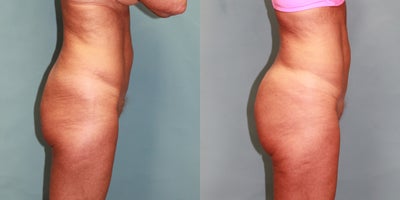 55-64 year old woman treated with Brazilian Butt Lift - Patient desired improvement in fullness of her buttocks, she underwent a Brazilian but lift taking fat from her abdomen and back and placing it in her buttocks