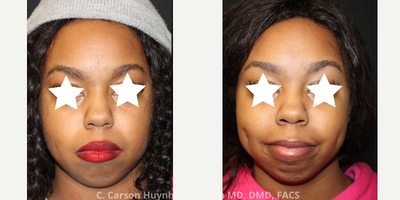 18-24 year old woman treated with Dimple Surgery - Cheek dimple surgery / dimpleplasty