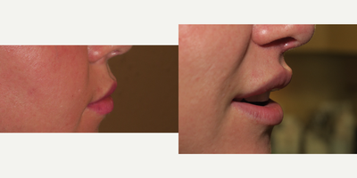 25-34 year old woman treated with Lip Lift - Lip Lift