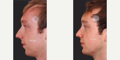 Man treated with Rhinoplasty - RHINOPLASTY W CHIN IMPLANT This patient wanted to correct the appearance of his nose, but in order to correctly balance the face, we had to add a chin implant. The patient was thrilled with the natural-looking results!