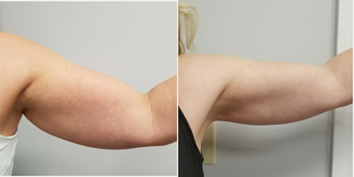 35-44 year old woman treated with UltraShape Power - 3 UltraShape Power treatments, photos taken at 3rd treatment.