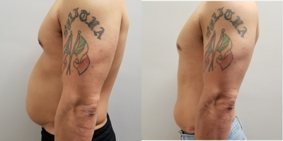 35-44 year old man treated with UltraShape Power - 3 UltraShape Power Treatments, after photos taken at 3rd treatment.