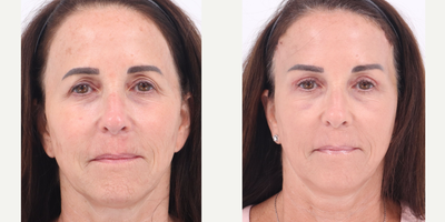 55-64 year old woman treated with Brow Lift, Eyelid Surgery - 3 weeks after Upper Blepharoplasty and Brow Lift.