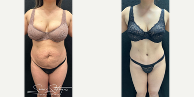 Woman treated with Lymphatic Massage - Woman treated with Vaser Liposuction of the posterior flanks and upper/middle/lower back, high definition Tummy Tuck with muscle plication, Brazilian Butt Lift, and 6 sessions of Lymphatic Massage.