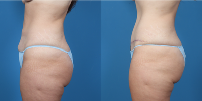 45-54 year old woman treated with Mommy Makeover - Bilateral breast augmentation with silicone gel implants and Abdominoplasty
