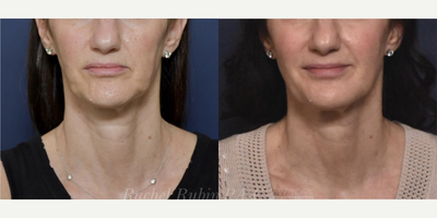 45-54 year old woman treated with Sculptra, Voluma, Restylane, Restylane Lyft, Restylane Defyne, Juvederm - A woman in her 50s, after the injection of 3 vials of Sculptra over 3 sessions for full-facial rejuvenation.