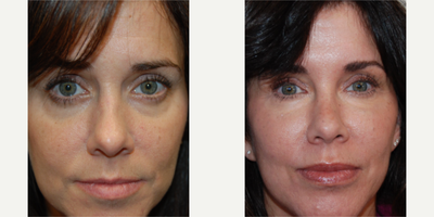 45-54 year old woman treated with Silikon 1000 - Our beautiful 51-year-old patient has been a patient of ours for 8 years. Along with Xeomin and Botox, she has received microdroplet Silikon-1000 to her cheeks, lips, nasolabial folds, under eye grooves, and jawline. Our patient's photos are an excellent demonstration of the safety, versatility, precision, and permanence of microdroplet Silikon-1000. Microdroplet Silikon-1000 injections are not associated with necrosis, embolism, stroke, blindness, or infection.