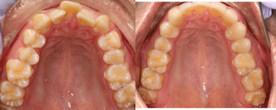 45-54 year old man treated with Six Month Smiles - The patient was interested in straightening his teeth but with traveling for work, traditional braces was not conducive with his lifestyle. After a thorough exam and consult with Dr Michaleson a treatment plan with phases was discussed with Rodney. Dr Michaelson started the first phase with Six month smile orthodontics and placing the tooth colored brackets and wires. Six month smiles employs the latest technology and techniques moving teeth with in an average of 6-9-months time. The patient&nbsp;came in approximately once a month for his orthodontic adjustment which worked with his schedule. After the braces were removed hewas able to whiten his teeth with Zoom in office and Dr Michaelson started phase two of the treatment. Now that his teeth were straight and aligned, his teeth had many different shapes and uneven lengths due to being worn down previous to wearing braces. Dr Michaelson recontoured his gum line to make the smile line even and placed 9 esthetic porcelain veneers across the upper teeth.&nbsp;