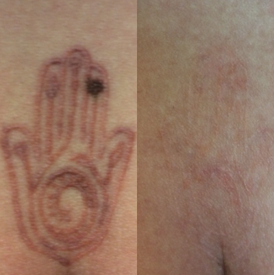 18-24 year old woman treated with PicoWay - Tattoo was removed with Pico Way after five treatments!