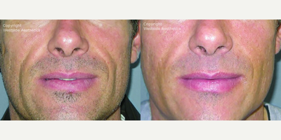 Bellafill Permanent Filler for Nasolabial Folds - This 48-year-old male patient was concerned with his deep nasolabial folds, but was not interested in the traditional, surgical face lift. Dr. Rivkin injected Bellafill, a permanent, collagen-based filler, to immediately add volume below the surface of his skin for smooth results.