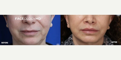 Woman treated with Lip Lift - Woman treated with Lip Lift
