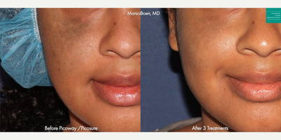 Man treated with PicoWay - PicoWay and PicoPlus lasers to treat Nevus of Ota on the face of a female patient by Dr. Boen