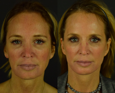  Halo Sun Damage Treatment - Reduce years of sun damage with the Halo Resurfacing Laser, an Erbium YAG laser which works to target fine lines and wrinkles, and improve the appearance of skin tone and texture. Results demonstrate significant improvement to the face, neck, and decollete and were taken before and three weeks after treatment. Our patient is now glowing with her younger looking skin.