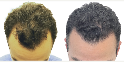38 year old man treated with Rogaine - This is a 38-year old male with progressive, androgenetic hair loss starting at about age 18. He was on finasteride for about 10 years when it first started but stopped at about age 28 because he just felt that he didnt want to be on oral medication anymore. Unfortunately, though, once he stopped the finasteride, his hair started falling out.More recently hed started daily minoxidil which was working well to prevent any more hair loss, but as expected, it didnt do anything to regrow the deepening recessions on both sides of his hairline. He was seeking restoration with surgery. You can really see those recessions once we shaved his head just prior to getting started. At the same time, he wanted a little more density behind his hairline in the frontal scalp, as well as a few grafts scattered over the crown, just to add a slight bit of density there.He had a 2461 graft FUE, with most of the grafts allotted to filling those recessions on either side of his hairline. We also added a few through the remainder of the frontal scalp and just a small amount in the crown.Hes had a great result! The recessions are restored and his hairline looks really natural! Hes still using his daily minoxidil to prevent ongoing hair loss and this is the kind of restoration that will age with him really naturally for decades to come. Even though we extracted more than 2400 grafts, weve done it in such a way that his donor area still looks really full. Youd really never be able to tell that this patient had a hair transplant!