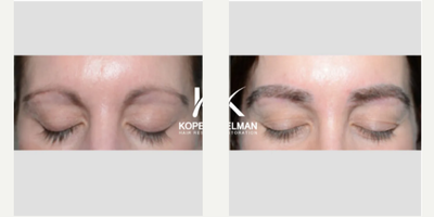 58 year old woman treated with Eyebrow Transplant - Sought to create a more arched brow shape. Photos taken before and six months after the procedure.