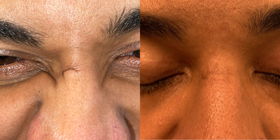 35-44 year old man treated with Scar Removal - 40 year old male underwent scar removal surgery under local anesthesia.