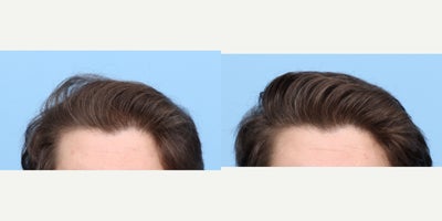 25-34 year old man treated with PRP Injections, PRP for Hair Loss, Hair Loss Treatment, FUE Hair Transplant, Hair Transplant - This patient started to notice hair loss for a few years and now is more noticeably thinning from the front to the crown. He's been wearing his hair in a longer style to cover this, but wanted a permanent solution. Dr. Wise performed an FUE hair transplant, during which he injected the patient with PRP to strengthen the follicles and expedite the healing process.