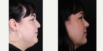 35-44 year old woman treated with Rhinoplasty, Chin Liposuction - Rhinoplasty, neck liposuction B&A