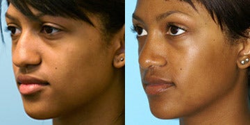African American Rhinoplasty Worth it? Reviews, Cost ...