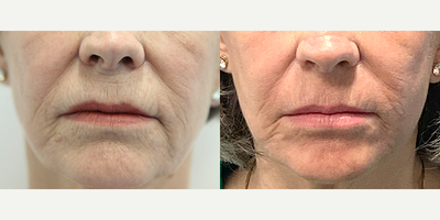 65-74 year old woman treated with CoolPeel - This patient had full face CoolPeel and perioral Tetra Co2 with nano fat grafting.