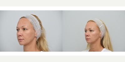25-34 year old woman treated with PicoWay, Skin Rejuvenation, SkinCeuticals - Picoway Laser with combination of skin care by Skin Ceuticals was used to treat melasma and skin rejuvenation.