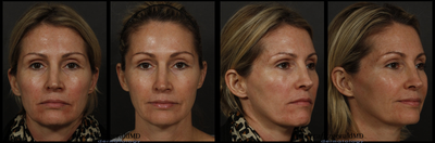 Sculptra - Patient desired more uplift accomplished with Sculptra to mid-face and temple areas. Results provide a more refreshed appearance.