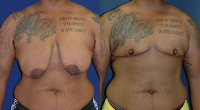 25-34 year old woman treated with Mastectomy - This patient is 34 years old, 5 7 and weighs 205 Lbs. He had a Bilateral Total Mastectomy with Free Nipple and Areolar Complex.