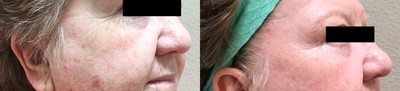 55-64 year old woman treated with Laser Resurfacing - I used the Cynosure (previously Palomar) Icon laser. Three for me. This patient received the Max G (for pigment and redness), XD (for wrinkles), XF (for superficial layer of skin) for her treatment. She also had thermismooth (4 treatments) to her crows feet.