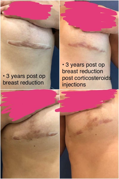 Had Scar Revision Surgery ~4 Years After the Breast Reduction