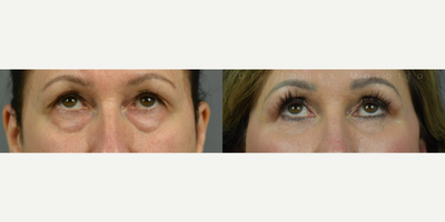 Woman treated with Laser Resurfacing - BlepharoplastyDeep Plane FaceliftFat GraftingLaser or Renuvion Skin ResurfacingSeptorhinoplasty