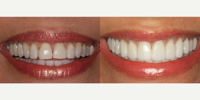 45-54 year old woman treated with Full Mouth Reconstruction - 45-54 year old woman treated with Full Mouth Reconstruction