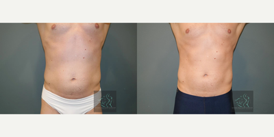 25-34 year old man treated with SculpSure - Patient treated with SculpSure to the abdomen.